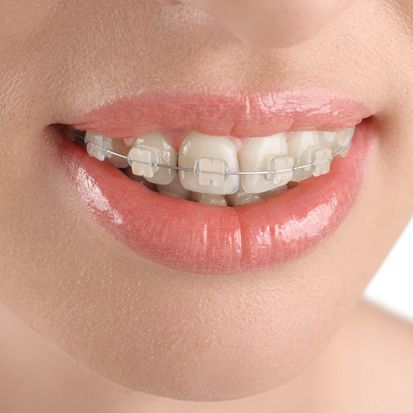 Niềng răng mắc cài sứ - Nha khoa Á Đông