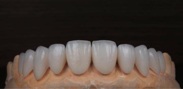 Dán sứ Veneer - Nha khoa Á Đông