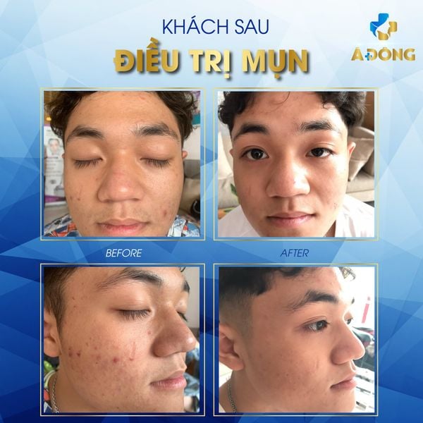 Feedback Trị Mụn Tại Á Đông