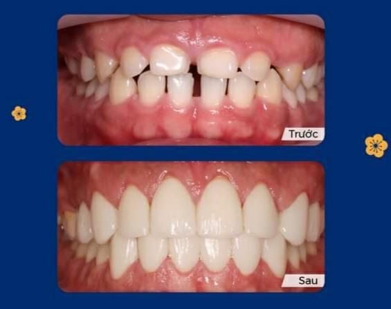 Bọc răng sứ - Nha khoa Á Đông