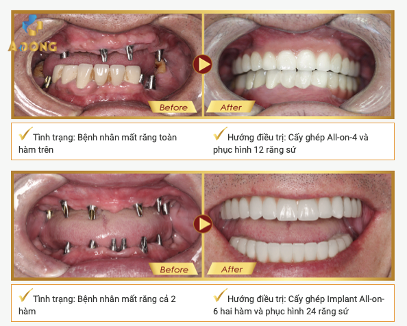 Trồng răng Implant - Nha khoa Á Đông