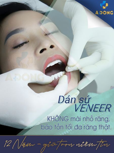 Dán Sứ Veneer- Phương pháp tối ưu để có được nụ cười hoàn hảo