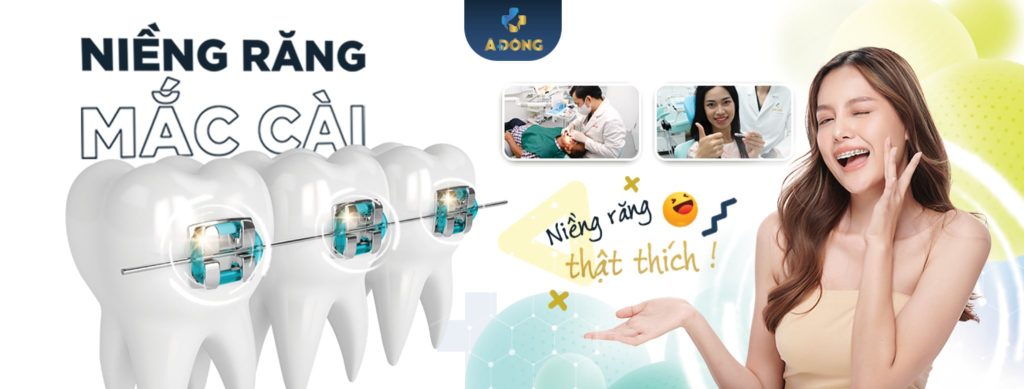 Niềng Răng Mắc Cài Kim Loại