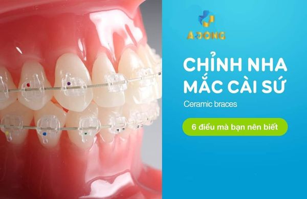 Niềng Răng Mắc Cài Sứ