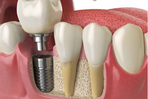 Các loại implant phổ biến - Nha khoa Á Đông