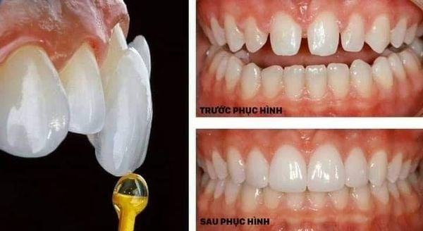 Dán sứ Veneer - Nha khoa Á Đông