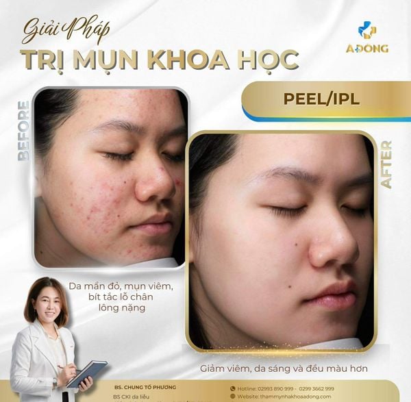 Điều trị da mụn an toàn – vì mỗi phác đồ đều được bác sĩ theo dõi sát sao