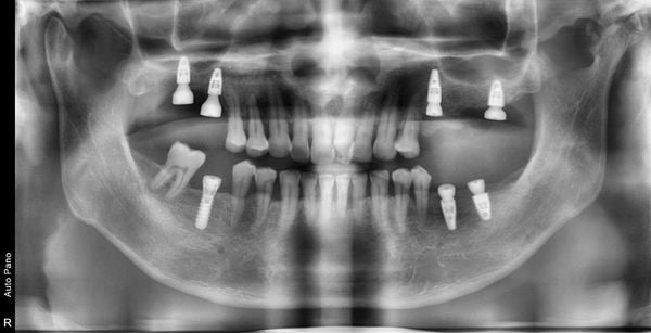 Trồng răng Implant - Nha khoa Á Đông