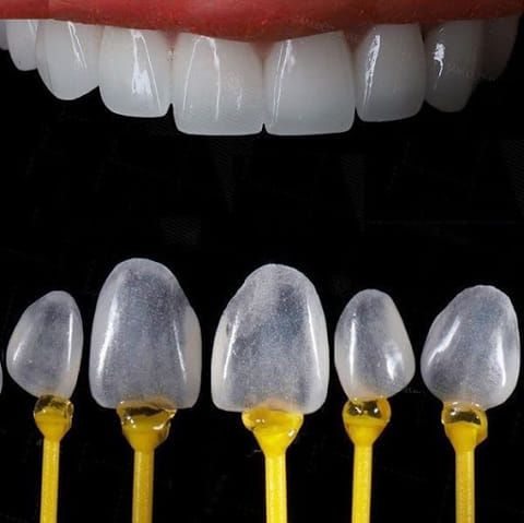 Dán sứ Veneer - Nha khoa Á Đông