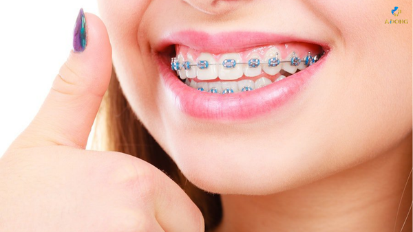 Hướng dẫn chăm sóc răng niềng đúng cách chuẩn nha khoa