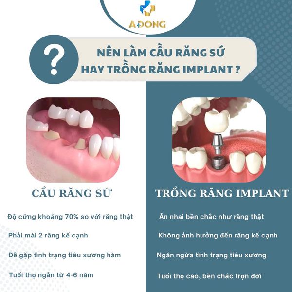 Phục Hình Răng Bị Mất Bằng Phương Pháp “Cầu Răng Sứ” hay ” Trồng Implant”