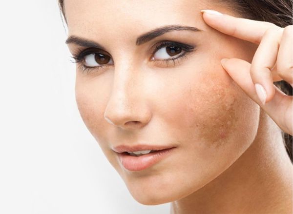 Top 5 lý do nên điều trị nám tại Thẩm mỹ Á Đông