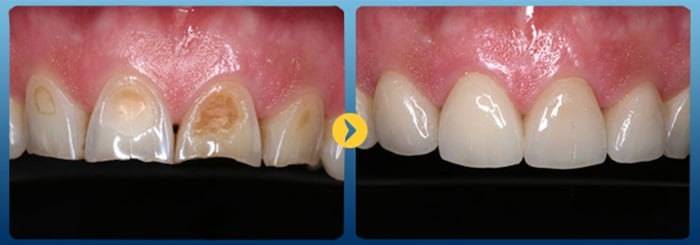 HÀN TRÁM RĂNG GIÁ BAO NHIÊU TIỀN TẠI NHA KHOA KIM 5