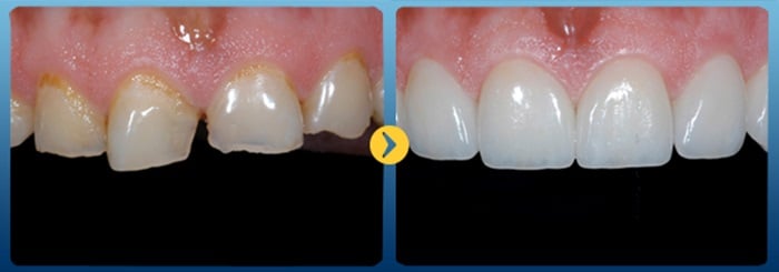 HÀN TRÁM RĂNG GIÁ BAO NHIÊU TIỀN TẠI NHA KHOA KIM 6