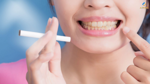 Cách tẩy trắng răng ố vàng hiệu quả và an toàn tại nhà