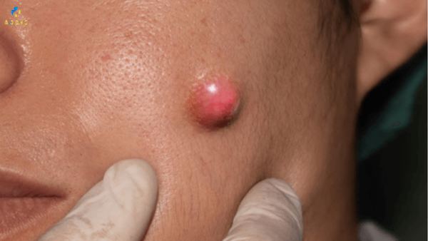 Cách trị mụn bọc hiệu quả, giảm sưng đau và ngăn ngừa sẹo