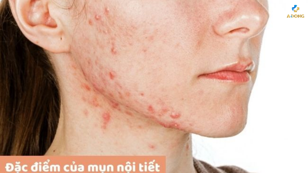 Cách trị mụn nội tiết ở cằm: Bí quyết cho làn da mịn màng