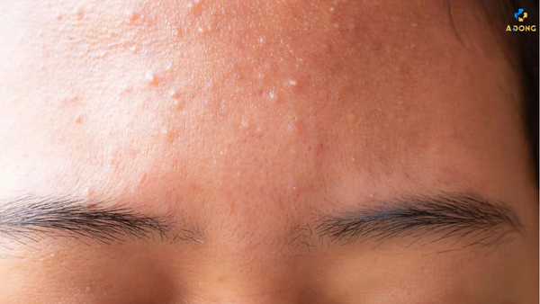 Cách trị mụn tại nhà hiệu quả và an toàn nhất hiện nay