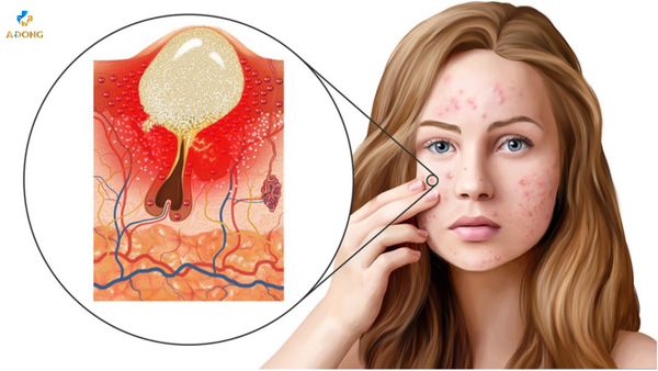 Top các cách trị mụn viêm hiệu quả tại nhà bạn nên thử