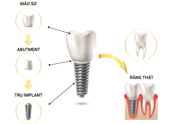 Cấy ghép răng implant