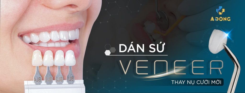 Dán Sứ Veneer