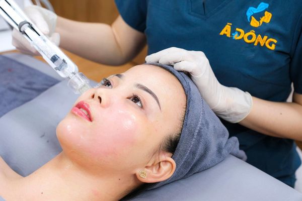 điều trị nám bằng laser
