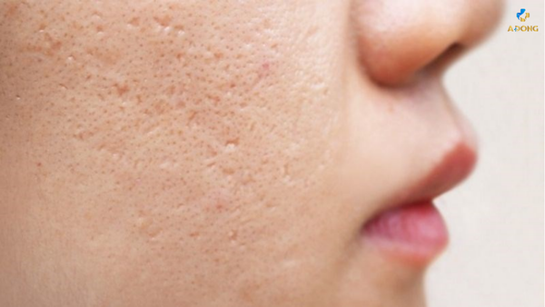 Phương pháp hiệu quả điều trị sẹo do mụn bằng laser