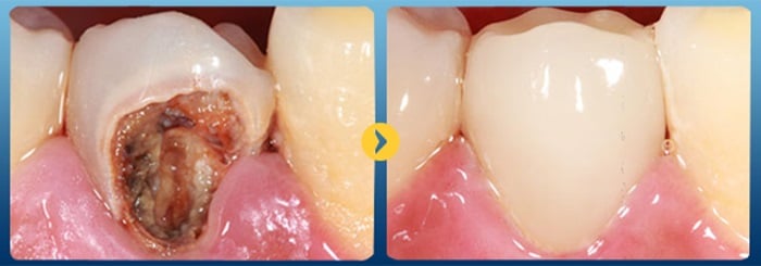 HÀN TRÁM RĂNG GIÁ BAO NHIÊU TIỀN TẠI NHA KHOA KIM 8