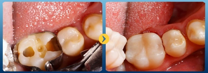 HÀN TRÁM RĂNG GIÁ BAO NHIÊU TIỀN TẠI NHA KHOA KIM 7