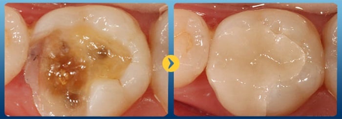 HÀN TRÁM RĂNG GIÁ BAO NHIÊU TIỀN TẠI NHA KHOA KIM 9