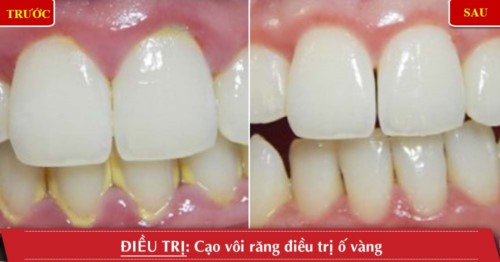 Cạo vôi răng tại nha khoa đông nam