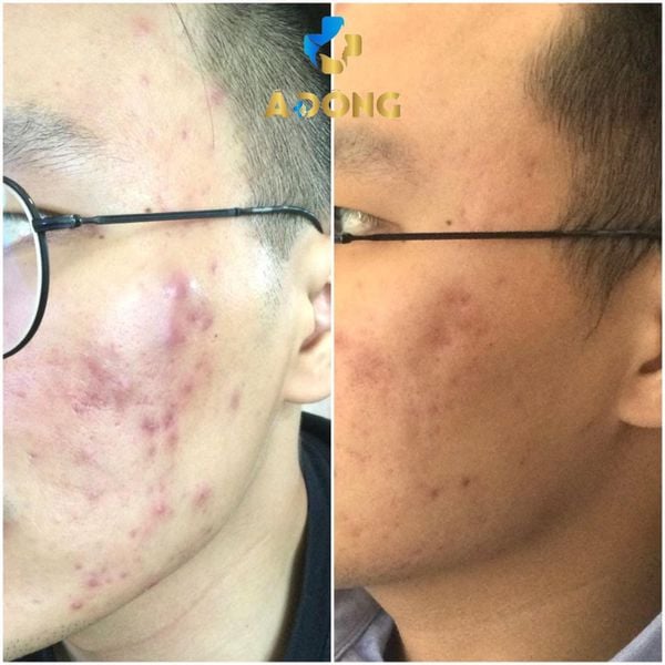 Các cách trị mụn phổ biến tại Thẩm mỹ Á Đông