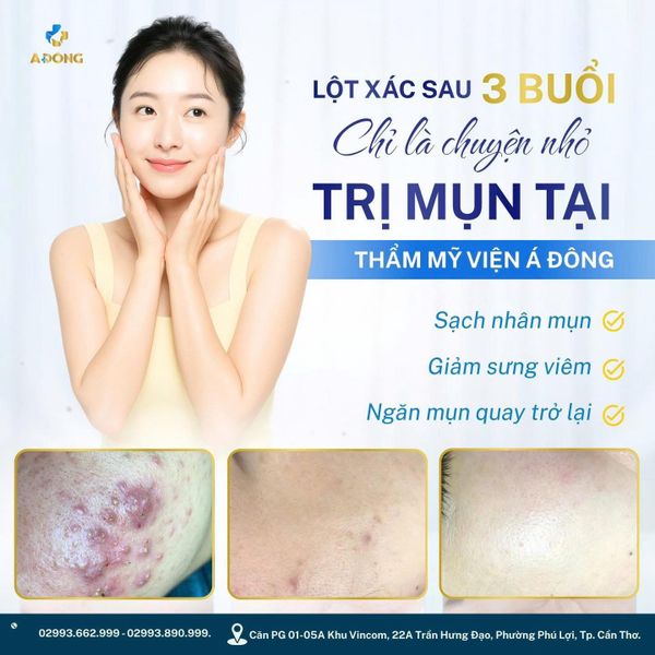 ✨ LỘT XÁC LÀN DA CHỈ SAU 3 BUỔI – CHUYỆN NHỎ TẠI THẨM MỸ VIỆN Á ĐÔNG ✨