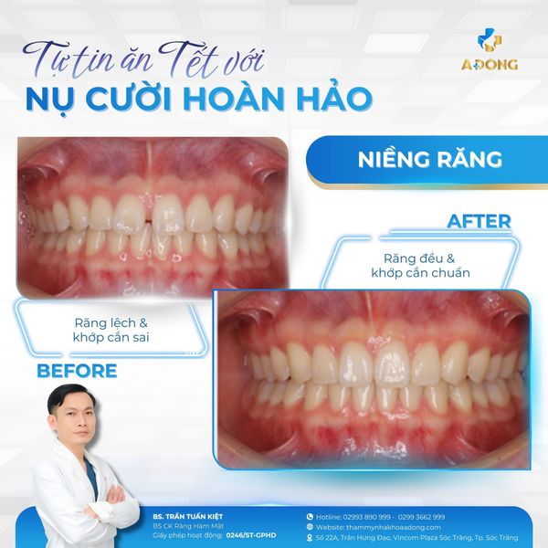 ✨Hết đau, hết lo khi niềng đúng kỹ thuật với bác sĩ Á Đông