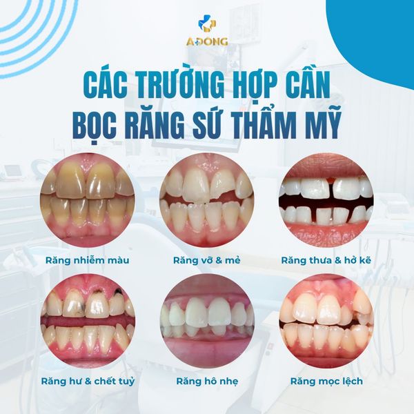 🦷 Răng chỉ xấu thôi chưa đủ — để lâu còn hỏng cả hàm