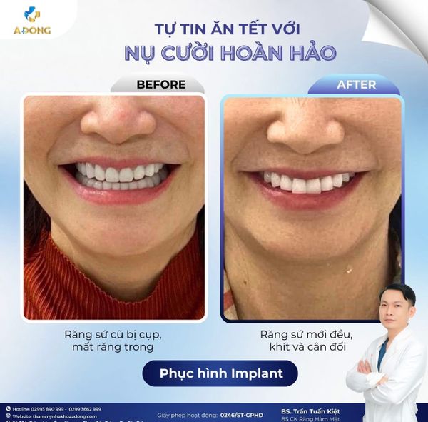 ✨ TỰ TIN ĂN TẾT VỚI NỤ CƯỜI HOÀN HẢO ✨