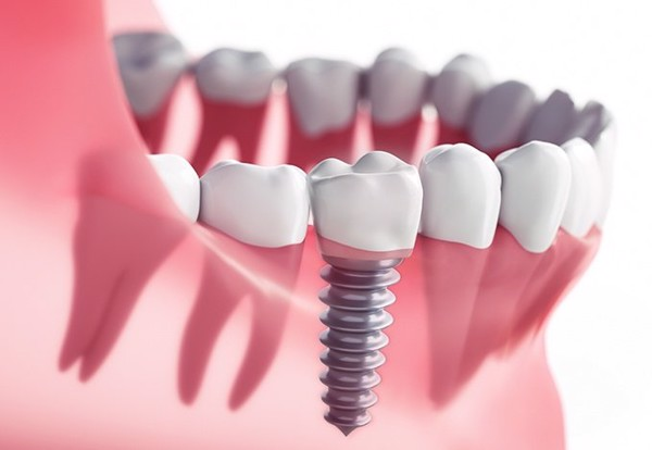 Các loại implant phổ biến - Nha khoa Á Đông