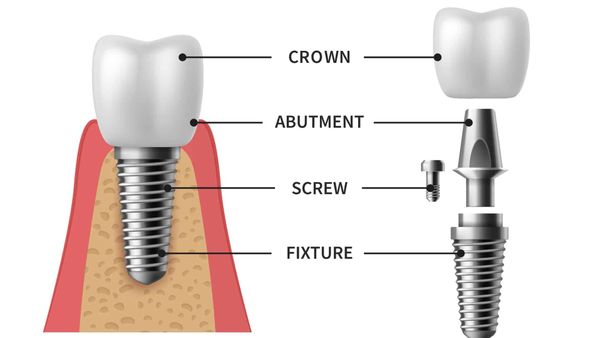 Top 3 loại implant phổ biến hiện nay