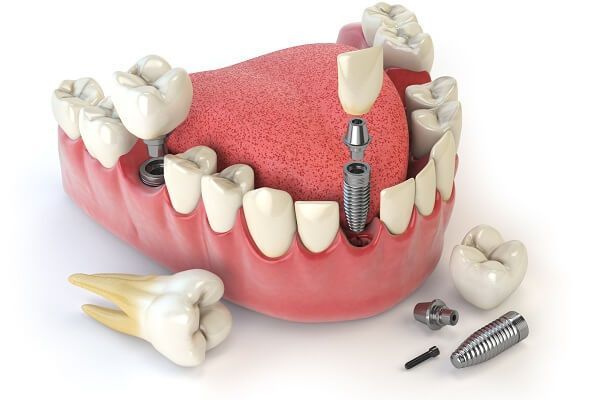Tiêu chí đánh giá xương hàm đạt tiêu chuẩn để trồng Implant