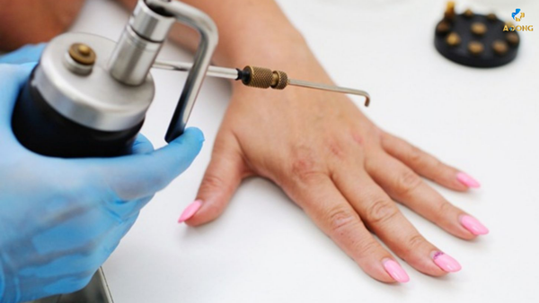 Liệu pháp áp lạnh: Giải pháp hiệu quả điều trị mụn cóc