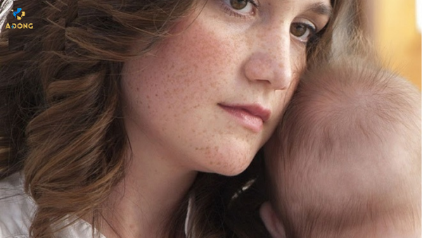 Kinh nghiệm trị nám sau sinh và nám nội tiết: Đặc biệt lưu ý