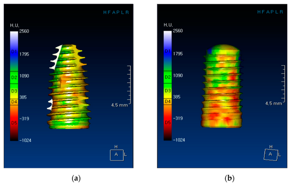 Trồng Implant - Nha khoa Á Đông