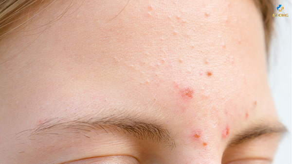Mụn ở trán: Nguyên nhân và giải pháp điều trị tại nhà