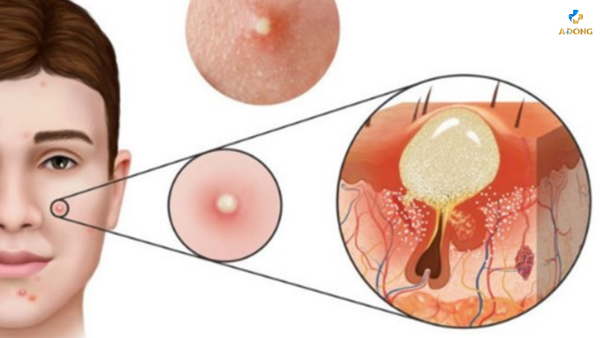 Trị mụn trứng cá bằng Vitamin A có thật sự hiệu quả?
