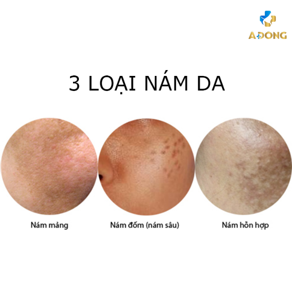 Địa chỉ trị nám tàn nhang uy tín tại Sóc Trăng hiệu quả