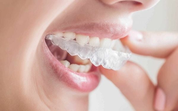Niềng răng trong suốt Invisalign - Nha khoa Á Đông
