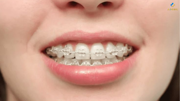 Niềng răng mắc cài sứ – Giải pháp thẩm mỹ và hiệu quả cho nụ cười