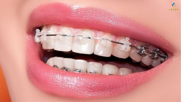 Niềng răng thẩm mỹ – Giải pháp tạo nên hàm răng hoàn mỹ