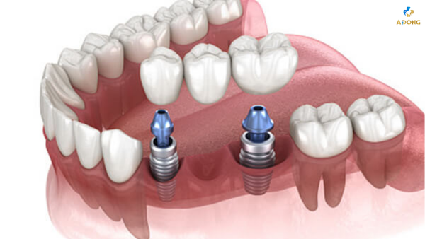 Trồng răng Implant – Giải pháp hoàn hảo cho nụ cười tươi sáng