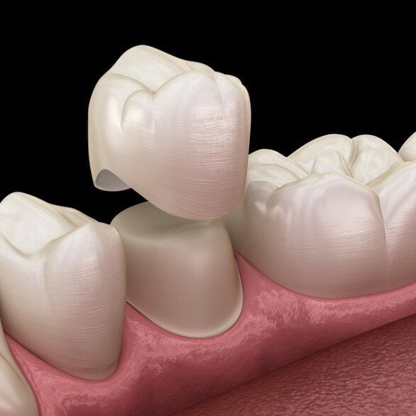 Bọc răng sứ - Nha khoa Á Đông